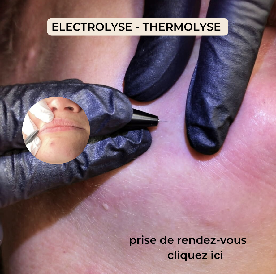 4. Thermolyse – La chaleur ciblée pour une épilation ultra localisée La thermolyse utilise une onde haute fréquence pour générer de la chaleur au niveau du bulbe du poil, le détruisant instantanément. Cette méthode est souvent utilisée pour les petites zones, les poils récalcitrants, ou en complément du laser ou de l’électrolyse.  ✨ Les avantages : Traitement rapide et ciblé  Idéal pour les petites zones comme le menton, les aréoles, les doigts  Peu invasive, sans produits chimiques  Résultats progressifs, visibles dès les premières séances  📌 Ce qu’il faut savoir : Les poils doivent être visibles  Zone non exposée au soleil avant/après  Parfait pour les finitions après un traitement global  💡 La thermolyse : précision, efficacité, et élégance du geste.