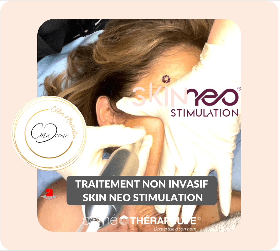 Traitement non invasif sans effraction cutanée nanoneedling lifting cutanée et regeneration cellulaires