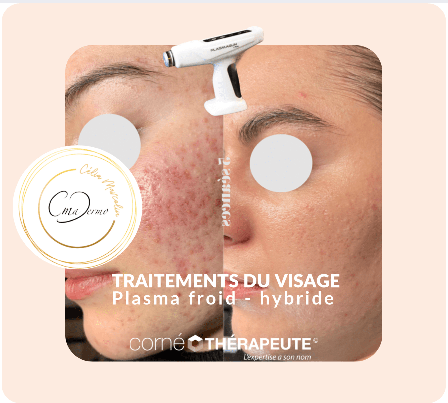 Traitements du visage Plasma trois et hybride idéal pour les peaux sensibles et cicatricielles